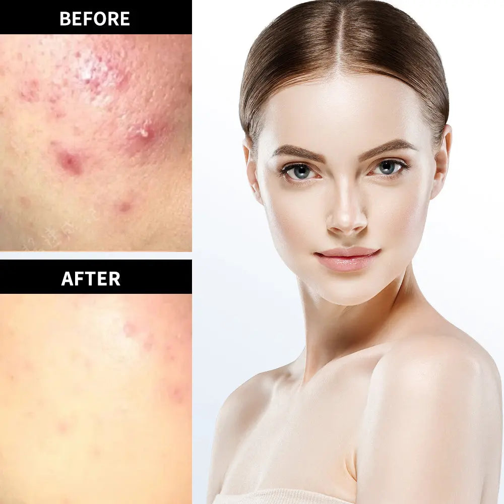 VGO Acne Removal Cream VGObeauty