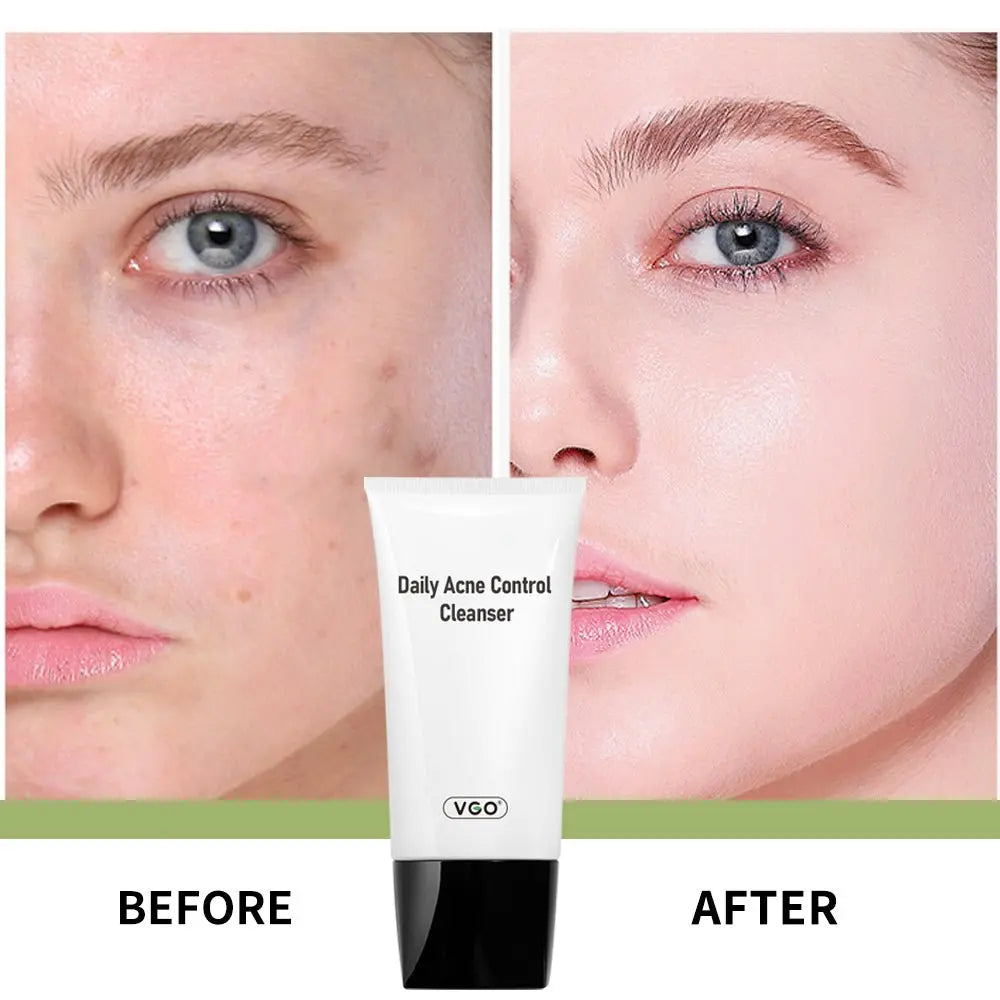 Daily Acne Control Cleanser - VGObeauty